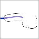 Silicone Dilator Set Silicone Dilator Set
